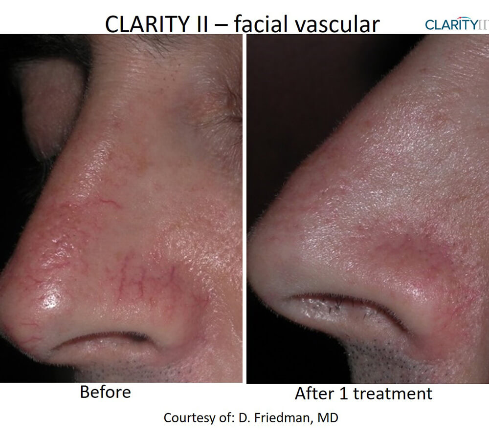 B&A Clarity II Friedman Nasal Veins